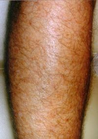 Laser Hair Removal Laser Hair Removal Legs - Jandali Plastic Surgery - Connecticut