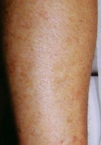 Laser Hair Removal Laser Hair Removal Legs - Jandali Plastic Surgery - Connecticut