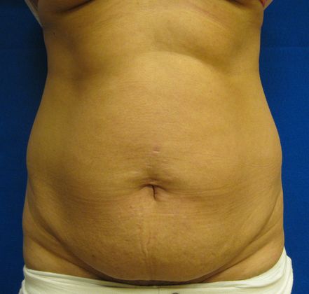 Before body contouring