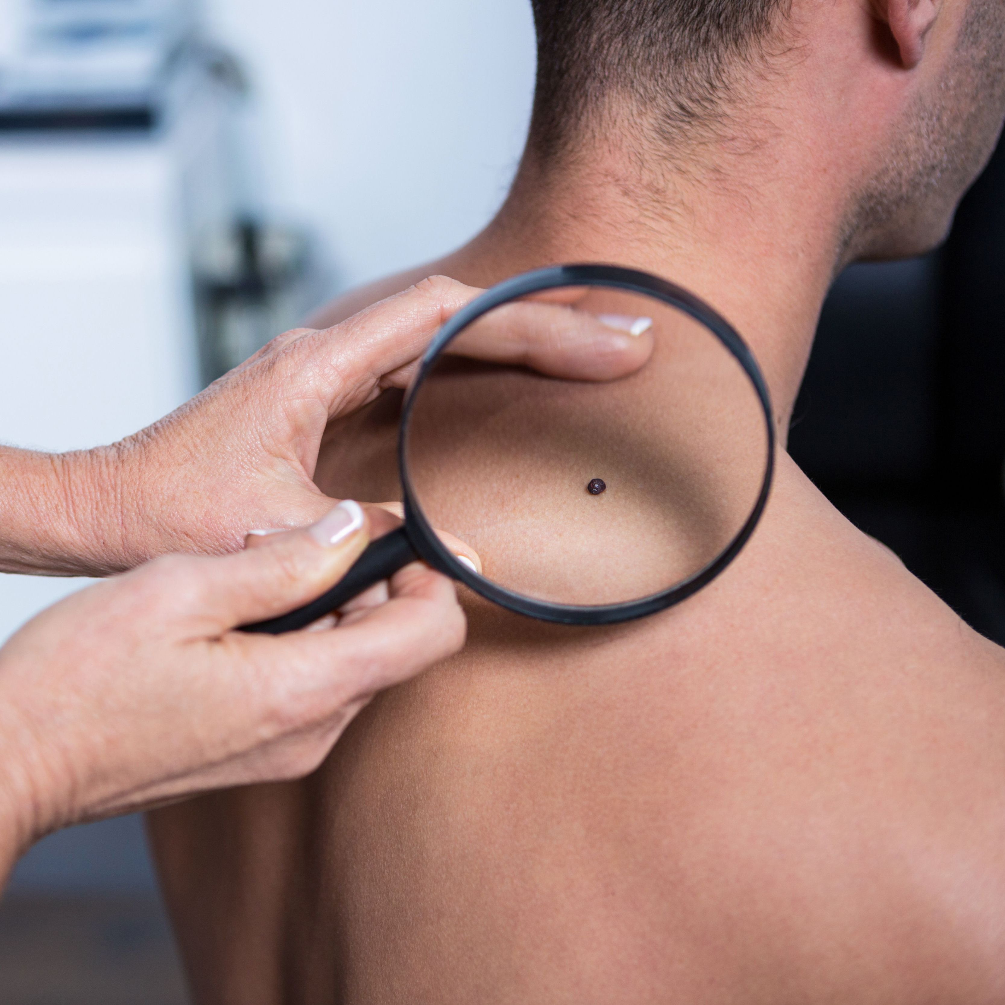 Man having mole examined
